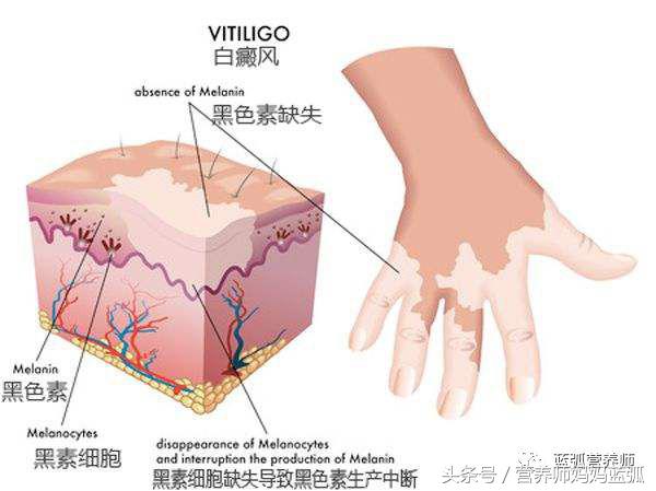 宝宝身上竟然长白斑，好担心是白癜风