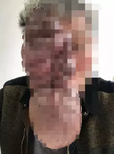 胎记突然疯长,男子为保命,只能“换脸”!胎记有这些特征要当心!
