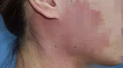 胎记突然疯长,男子为保命,只能“换脸”!胎记有这些特征要当心!