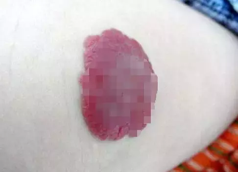 胎记突然疯长,男子为保命,只能“换脸”!胎记有这些特征要当心!