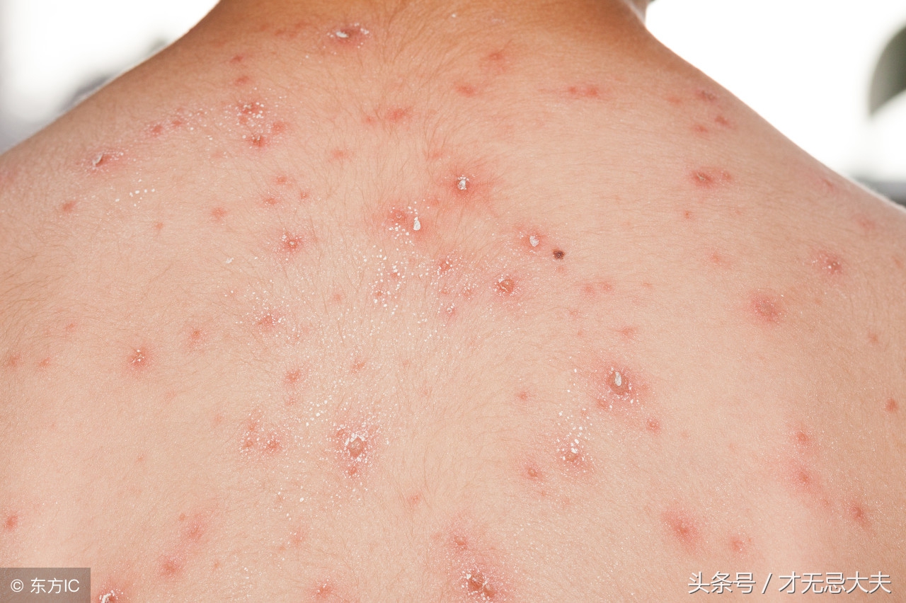 水痘大约经过斑疹 丘疹 疱疹 结痂过程,由于病毒分批释放,也可以同