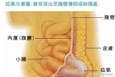 宝宝小蛋蛋肿了一大块，还会随着站姿坐姿变大变小！咋回事？