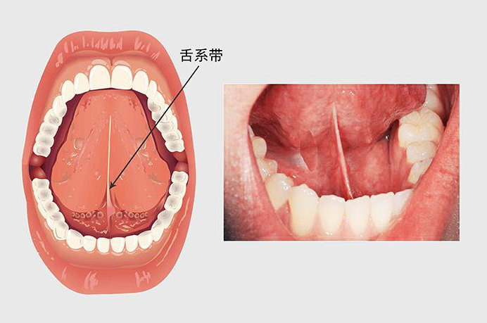 说话大舌头怎么矫正（大舌头语言矫正六部训练法）