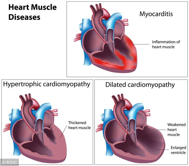 扩张型心肌病的病因是什么？如何使扩大的心脏再缩小