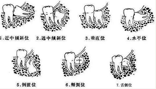 爱牙日：一颗智齿的忠告