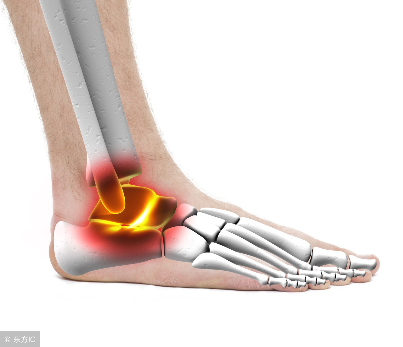 "足底筋膜炎"和"跟骨骨刺"有区别吗?