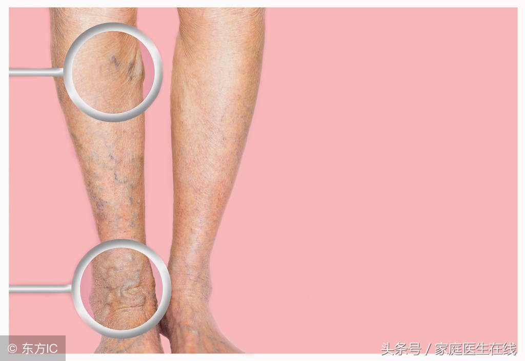 下肢出现这些异常，不用怀疑，就是发生静脉曲张了