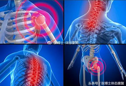 「运动康复科普」浑身肌肉总是酸痛难忍？纤维肌痛症大家了解一下