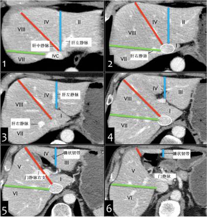 肝脏图片位置示意图(这份肝脏解剖图解，不收藏就亏了！)