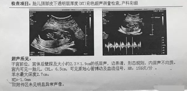 3个月胎儿正常彩超单，这些数据很关键，9个指标要弄清，NT很重要