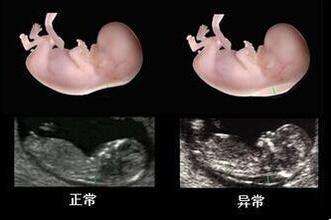 3个月胎儿正常彩超单，这些数据很关键，9个指标要弄清，NT很重要