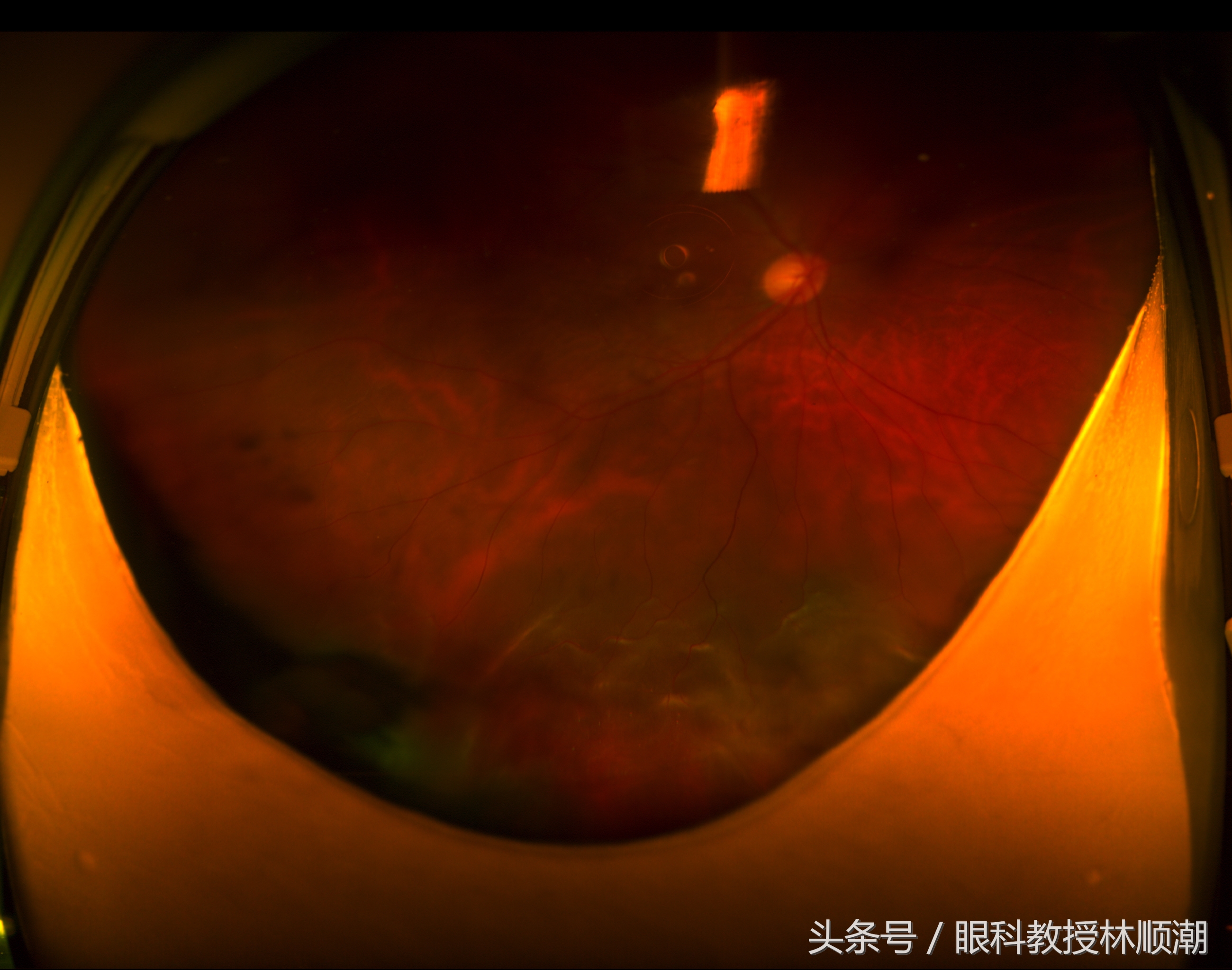 香港男子视网膜脱落9日才就医！幸好因为他，视力恢复到了0.6