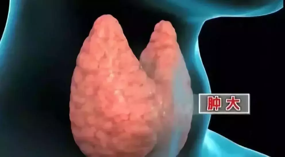 甲亢、甲减、甲状腺结节怎么办?三分钟看懂报告,预防治疗更轻松