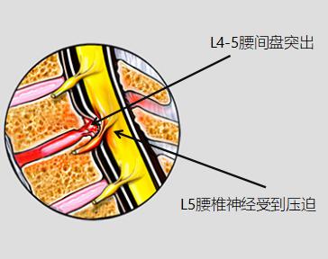 腰椎影像学报告单，你看懂了吗？