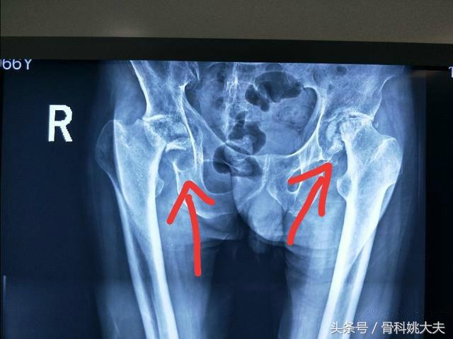 股骨头坏死应该如何治疗？医生告诉你答案！
