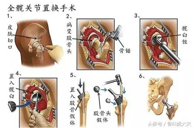 股骨头坏死的治疗方法与康复指南