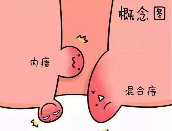 内痔的诊断主要从以下几个方面:第一,便血的症状内痔好发于年轻人