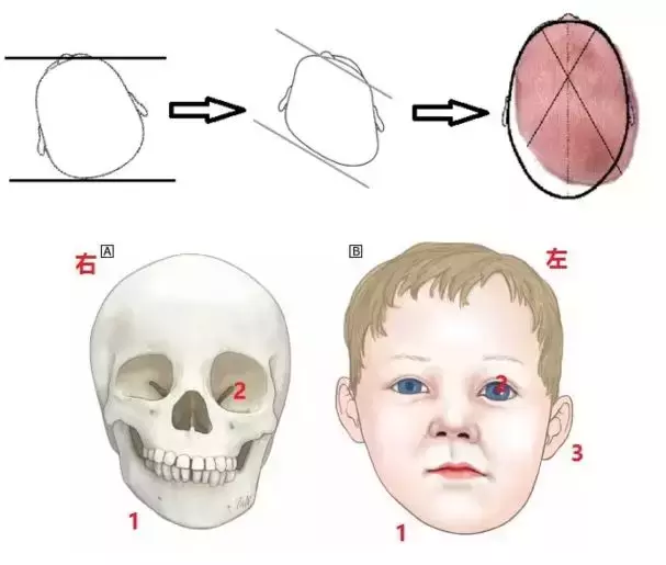 寶寶額頭骨頭凸起圖片(寶寶偏頭) - 赤虎壹號