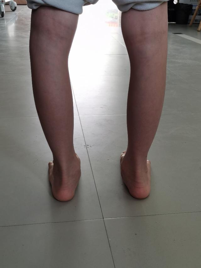 什么是足外翻?需要治疗吗?