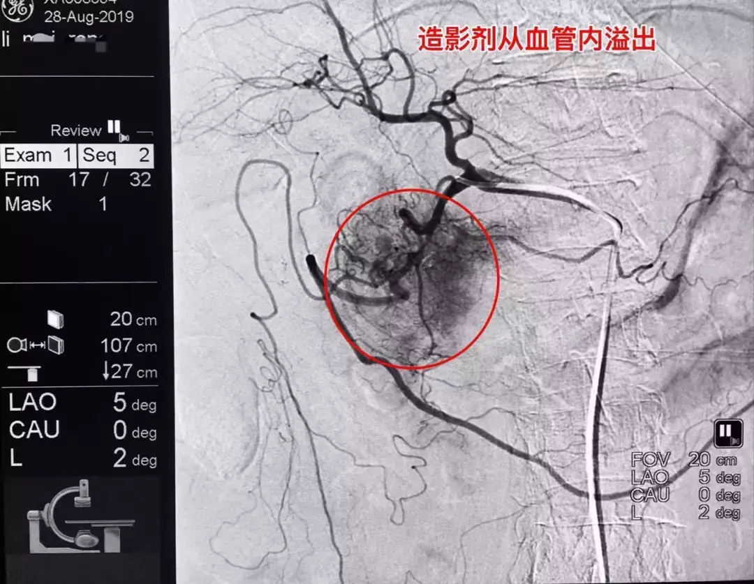 76岁老人急性胃出血1500ml,用了这种“武器”,马上止血