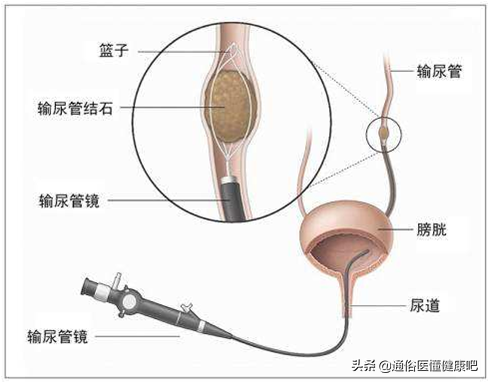 体外冲击波“碎石”和输尿管软镜“取石”，谁更“胜”一筹？