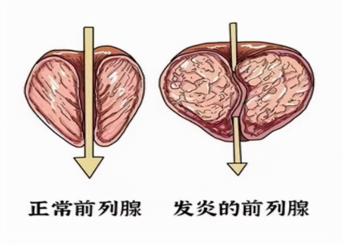 5药多角度松弛膀胱平滑肌，抑制前列腺增生，缓解尿频尿急尿失禁