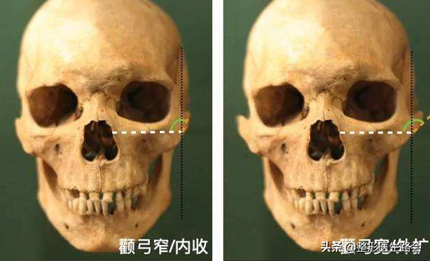 关于颧骨颧弓内推极限：推越多越好吗 脸部会松垮吗……