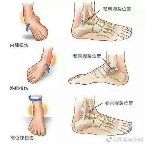 崴脚后如何初步判断骨头是否受伤