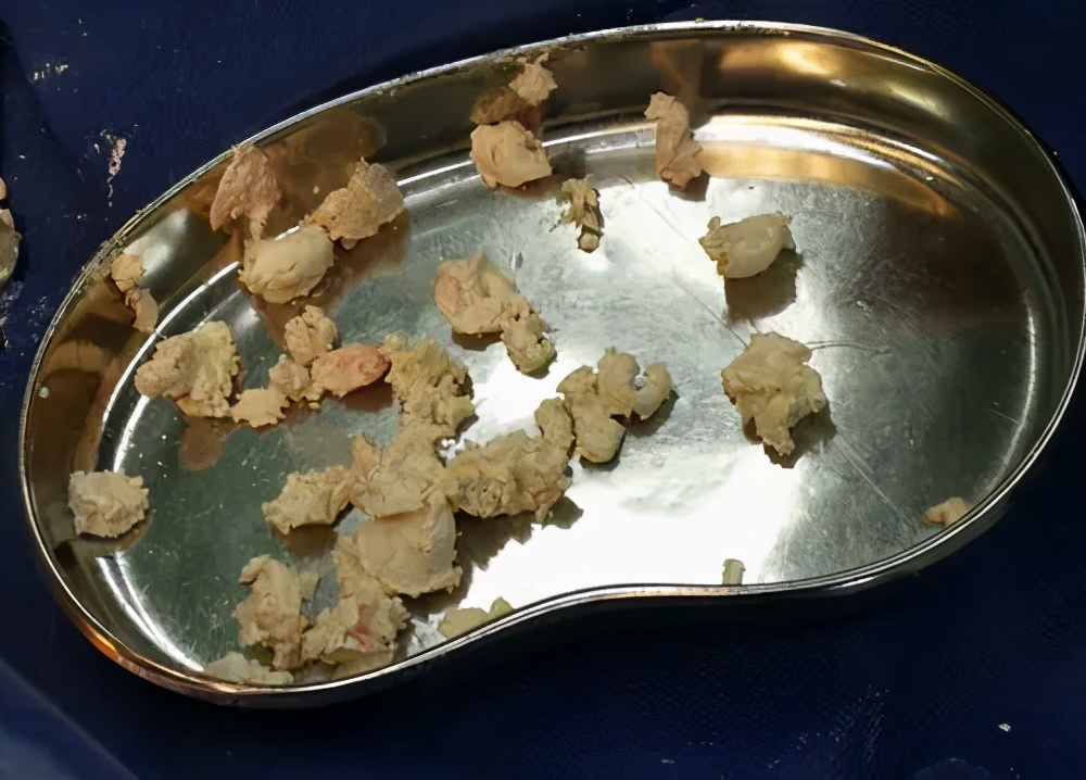 痛风患者快收好！照着“食物嘌呤表”吃，尿酸被“治得”服服帖帖