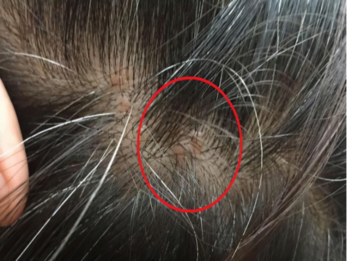 头皮长痘痘是怎么回事为什么头皮老是长疙瘩