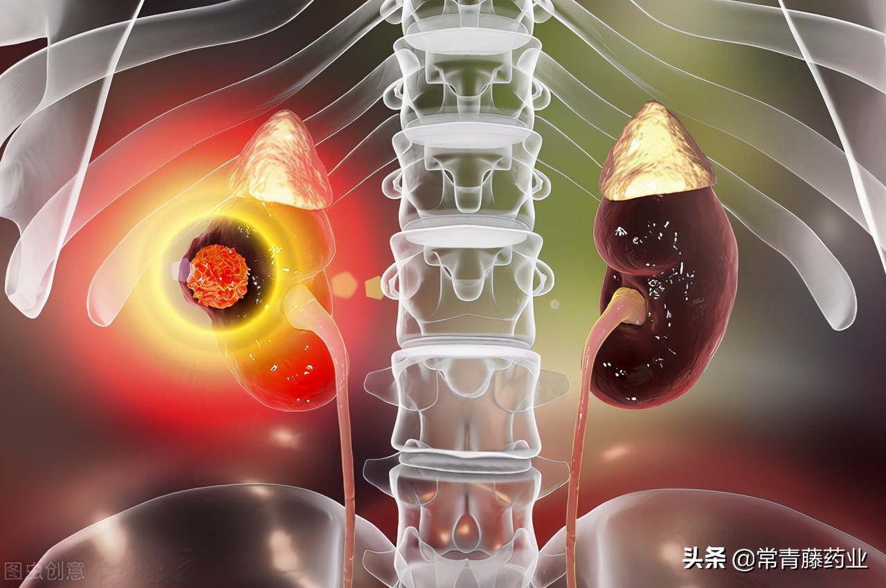 肾癌有什么治疗？了解一下，根治性肾切除术、保留肾单位手术