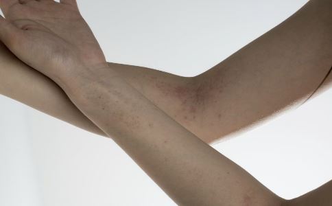 吃海鲜过敏怎么办海鲜过敏的症状吃海鲜过敏的解决方法及时有效