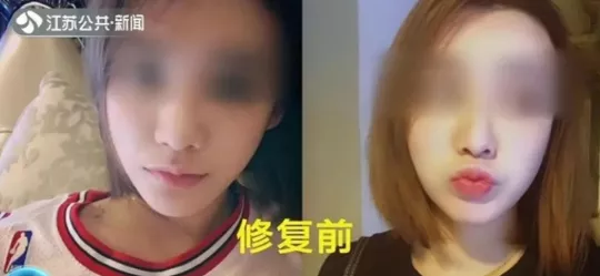 女主播花2万多做“隆鼻”,整完鼻子变4个洞