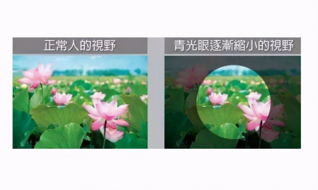 青光眼该如何治疗呢？