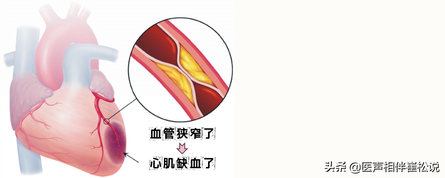 心电图上的T波改变严重吗？！是不是心肌缺血？！
