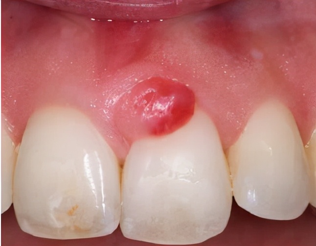 牙瘘管怎么治疗图片