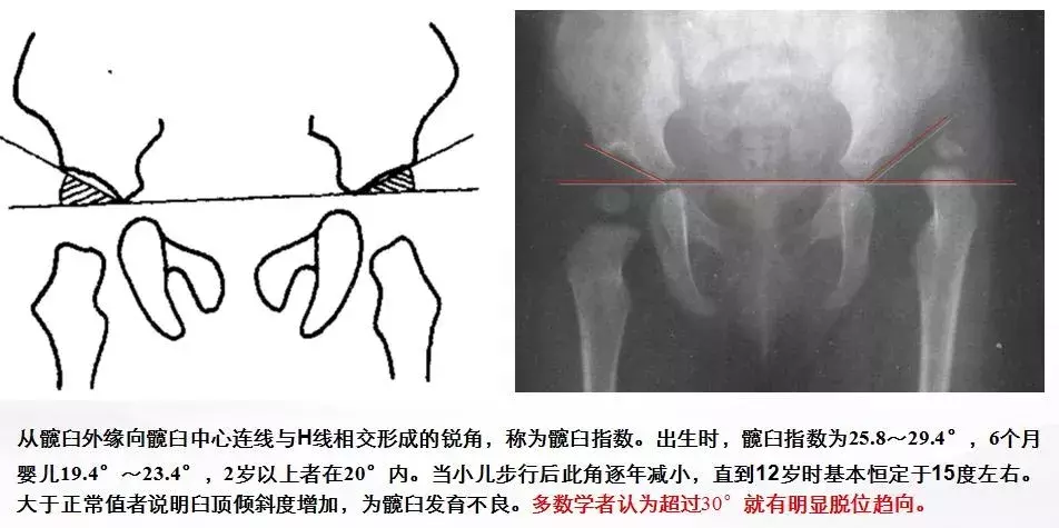 宝宝臀纹不对称妈妈不上心，长大后孩子走路一瘸一拐