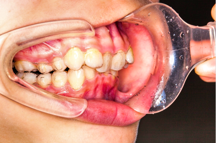 告诉你牙龈肿痛的几种原因