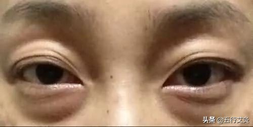 艾灸帮你调理眼袋