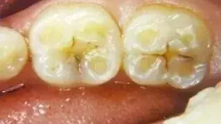 “酸倒牙”是怎么回事?能自行治好吗?