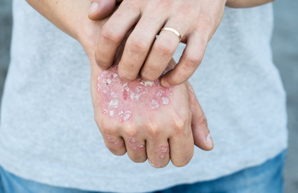 猫抓病的红斑丘疹图片(女子腋窝有肿块) - 赤虎壹号