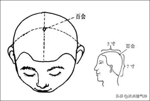 按揉百会、会阳、长强、承山穴，提肛运动治疗痔疮