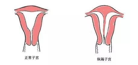 发现纵隔子宫的女孩，还能怀孕生子吗？