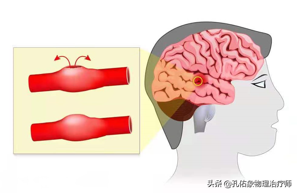 为何如此多的人发生脑出血？要如何正确应对？一文详细告知您