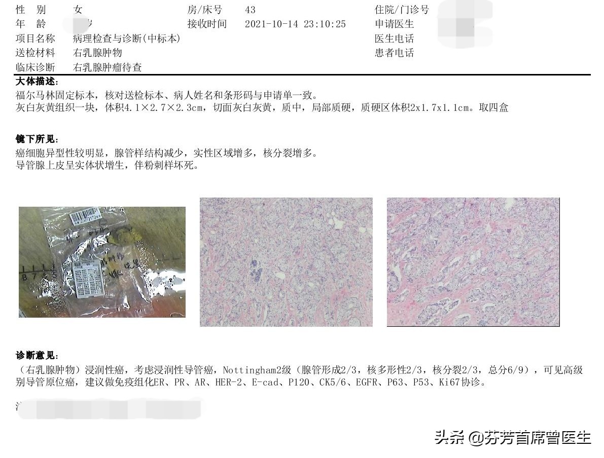 女子发现乳腺肿瘤24年，不痛不痒，以为是良性的，没想到却癌变了
