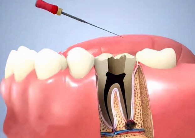 牙龈瘘管治疗多少钱(牙龈挤掉脓包后还反复长) 