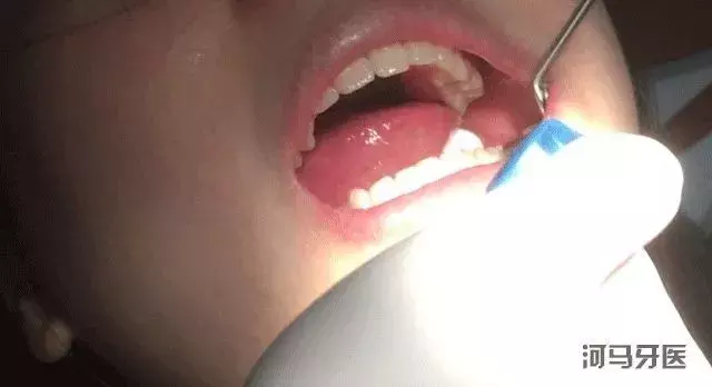 涂氟能预防蛀牙!孩子多大能涂?多长时间涂一次?需要注意啥?