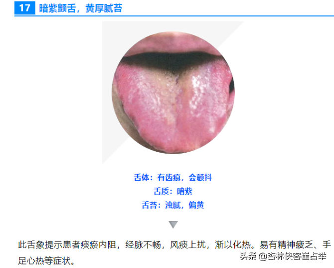 如何通过舌头，分辨心脑血管疾病、中风前兆？教你一招，快速辨别