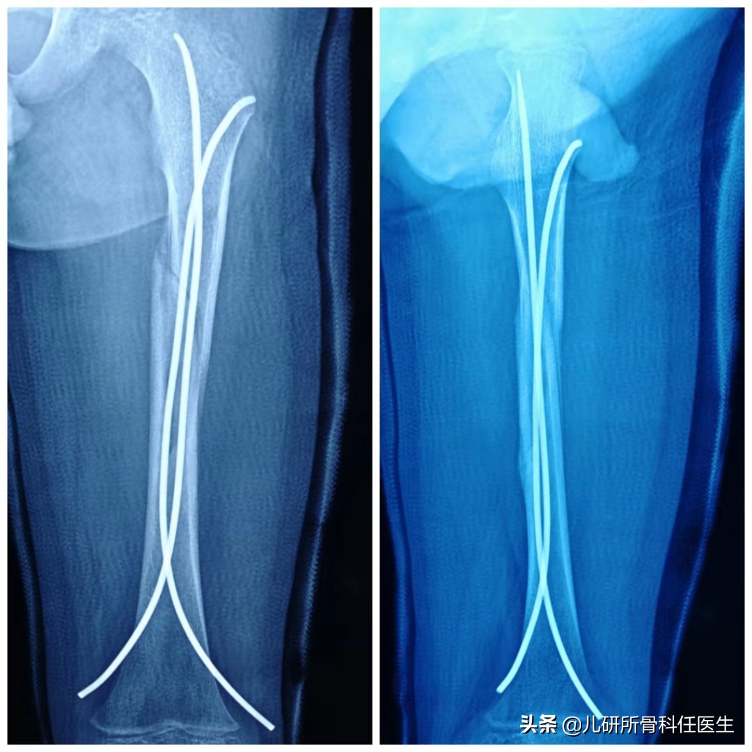辟谣|骨折就应该打石膏或者放钢板?这些治疗方法少见但有效