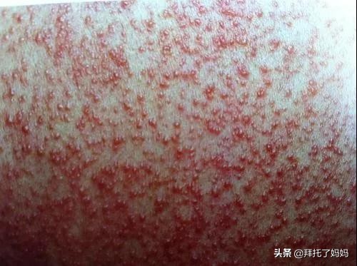 水晶痱、红痱、脓痱，不同痱子护理方法大不同，妈妈要学会分辨